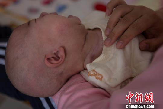 孩子出生后第15天,于丽静发现小坚果颈部右边比左边粗,而且长出了花生米大小的包块。孩子满月时已长到鸡蛋黄那么大。图为术后小坚果的脖颈处留下的伤疤。范丽芳 摄 孩子出生后第15天,于丽静发现小坚果颈部右边比左边粗,而且长出了花生米大小的包块。孩子满月时已长到鸡蛋黄那么大。图为术后小坚果的脖颈处留下的伤疤。范丽芳 摄