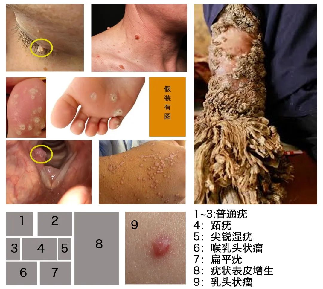 图9。 HPV引起的各种皮肤或黏膜疣状病变