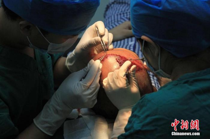 资料图：医生为患者进行植发。a target='_blank' href='http://www.chinanews.com/'中新社/a发 潘旭临 摄